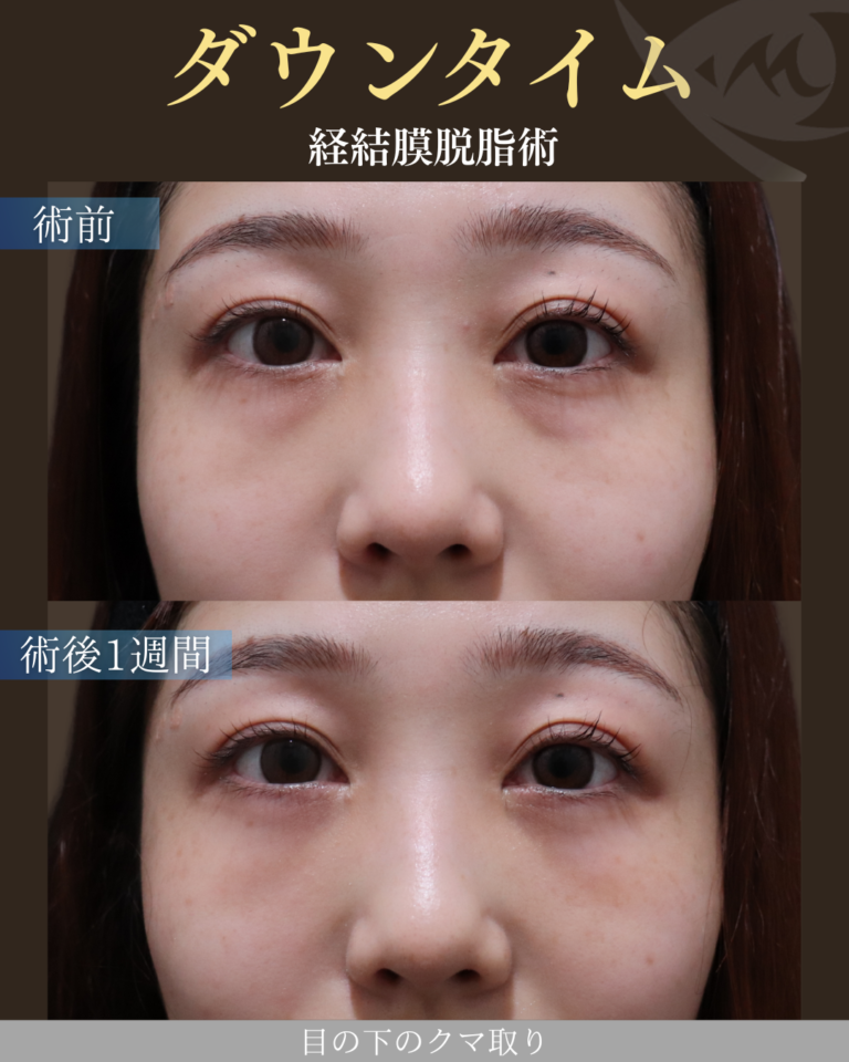 20代女性 経結膜脱脂術 ダウンタイム